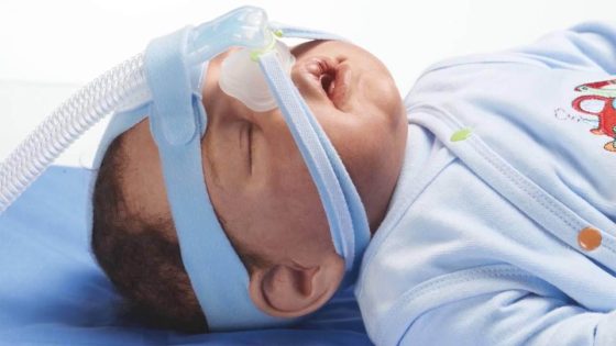 مراكش: سابقة..إجراء أول تقنية بالمغرب لعلاج اختناق حديثي الولادة