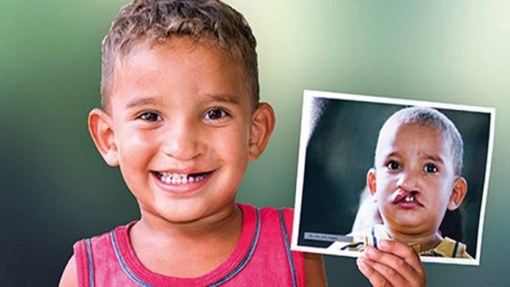 عملية smile الأمريكية تعود مجانا يناير المقبل بمستشفيات المغرب