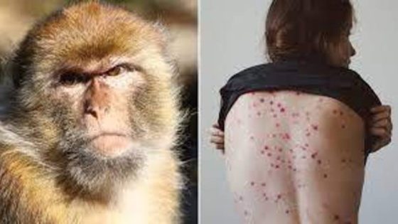وزارة الصحة تؤكد أن النتائج المخبرية للحالات الثلاث المشتبه في إصابتها بفيروس جدري القردة جاءت سلبية